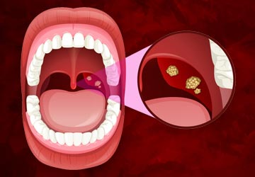 Swollen Adenoids
