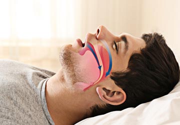 Nasal airway obstruction